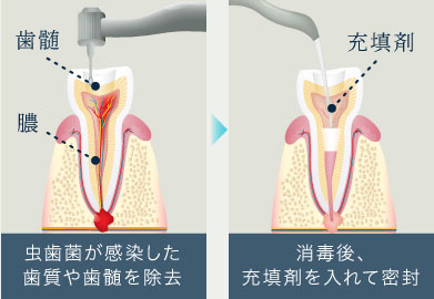 虫歯菌が感染した歯質や歯髄を除去→消毒後、充填剤を入れて密封