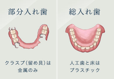 部分入れ歯…クラスプ（留め具）は金属のみ／総入れ歯…人工歯と床はプラスチック