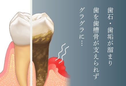 歯石・歯垢が溜まり、歯を歯槽骨が支えられずグラグラに…