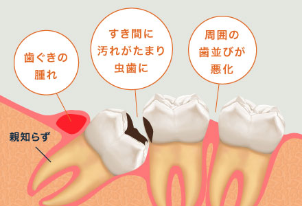 ＜親知らずの影響＞歯茎の腫れ／隙間に汚れがたまり虫歯に／周囲の歯並びが悪化